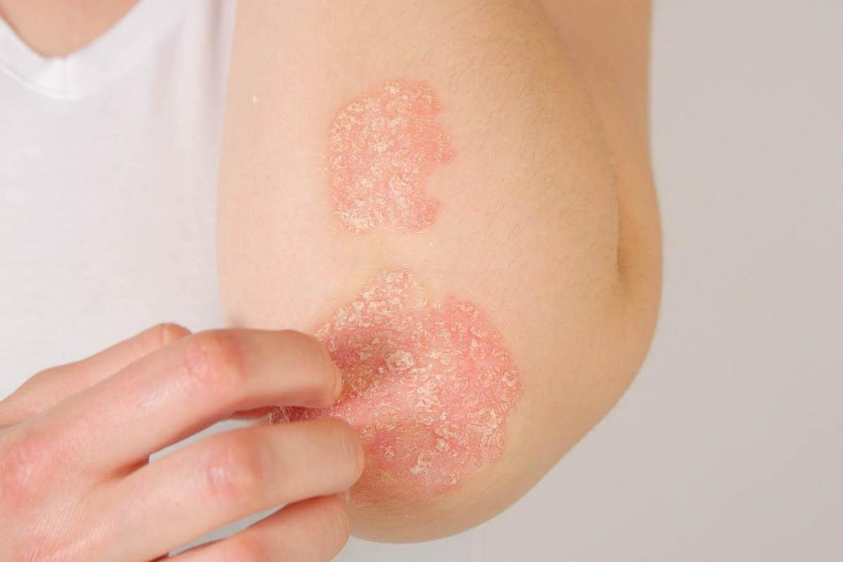 bras avec de l'eczema