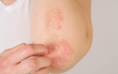 Treatment of eczema