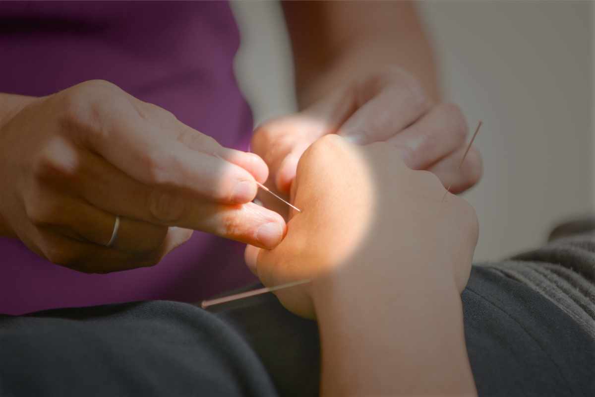 Acupuncture in the hand - zoom